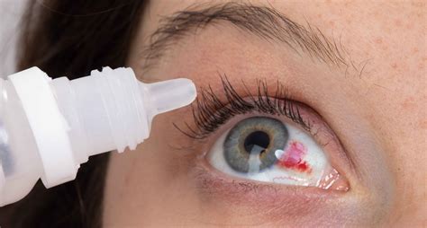 Los CDC reportan nueva muerte relacionada a gotas para los ojos contaminadas